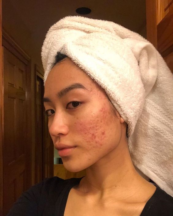 Beauty Diaries: How I (mostly) cleared my hormonal acne after 10 years (фото 10)